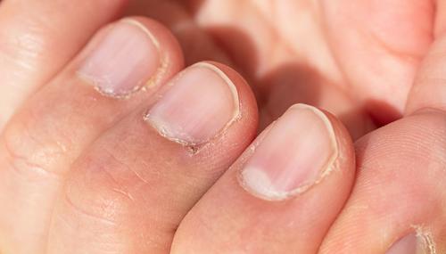 Почему болят ногти на ногах. Заболевания ногтей на ногах 05 Почему болят ногти на ногах. Заболевания ногтей на ногах 05