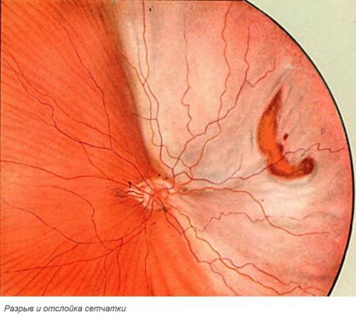 Узнайте о четырех типах отслоек и как избежать их 02