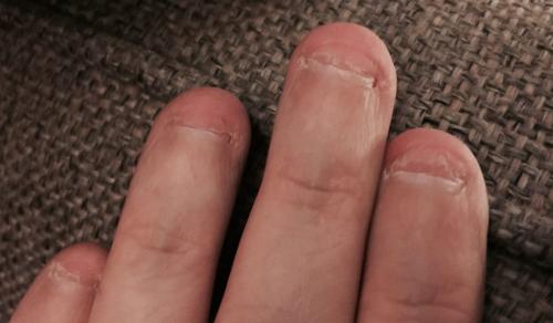 Как новая терапия влияет на качество жизни пациентов с ониходистрофиями. Врожденные ониходистрофии