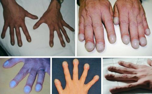 Как новая терапия влияет на качество жизни пациентов с ониходистрофиями. Врожденные ониходистрофии