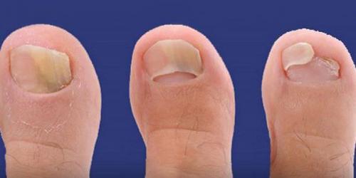 Как новая терапия влияет на качество жизни пациентов с ониходистрофиями. Врожденные ониходистрофии