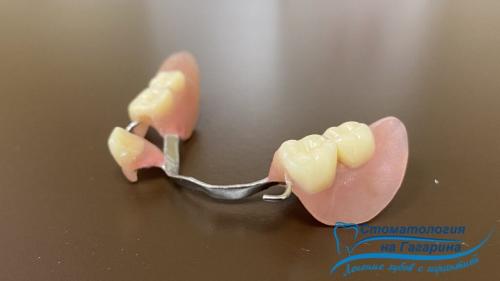 В чем разница между бюгельными протезами и имплантами. Бюгельный протез на микрозамках или имплантация?