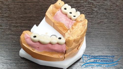 В чем разница между бюгельными протезами и имплантами. Бюгельный протез на микрозамках или имплантация?