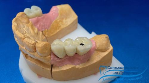 В чем разница между бюгельными протезами и имплантами. Бюгельный протез на микрозамках или имплантация?