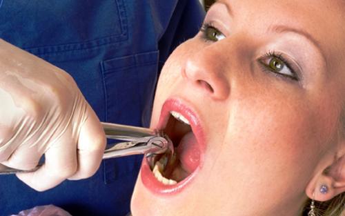 Сравнение различных типов бюгельных протезов: какой выбрать 13 Сравнение различных типов бюгельных протезов: какой выбрать 13