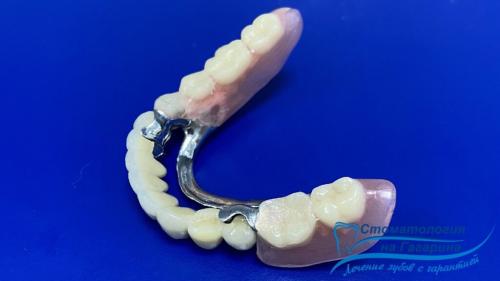 В чем разница между бюгельными протезами и имплантами. Бюгельный протез на микрозамках или имплантация?