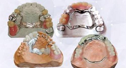 Сравнение различных типов бюгельных протезов: какой выбрать 01 Сравнение различных типов бюгельных протезов: какой выбрать 01