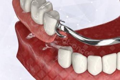 Сравнение различных типов бюгельных протезов: какой выбрать 03 Сравнение различных типов бюгельных протезов: какой выбрать 03