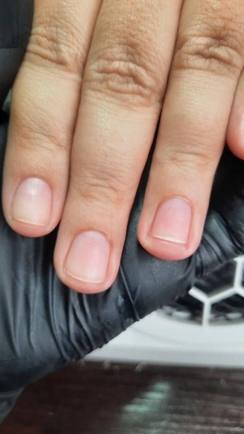 Наш конечный результат в восстановлении после химического ожога. 03 Наш конечный результат в восстановлении после химического ожога. 03