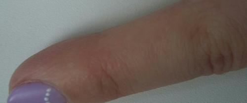 Девочки, помогите пожалуйста, по одному пальцу пошли маленькие пупырышки, зудят и чешутся. 02