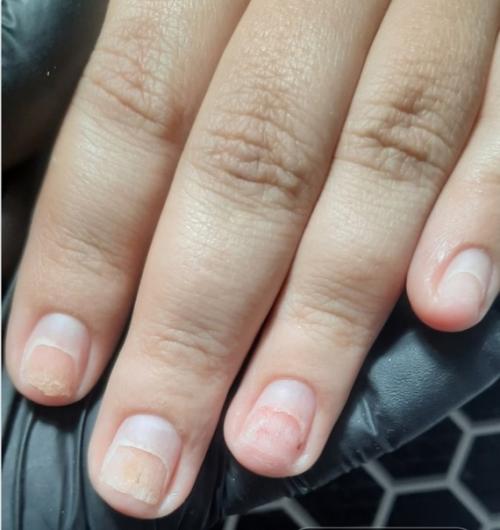 Наш конечный результат в восстановлении после химического ожога. 04 Наш конечный результат в восстановлении после химического ожога. 04