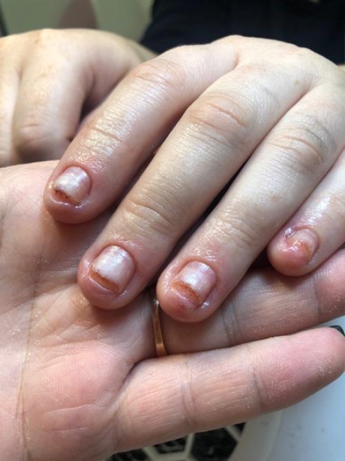 Аллергия на гель - лак: причины, симптомы, лечение. 06 Аллергия на гель - лак: причины, симптомы, лечение. 06