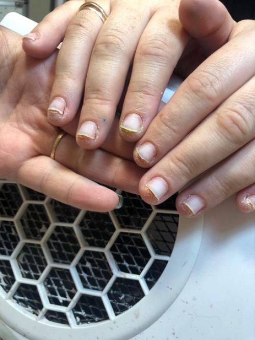 Аллергия на гель - лак: причины, симптомы, лечение. 03 Аллергия на гель - лак: причины, симптомы, лечение. 03