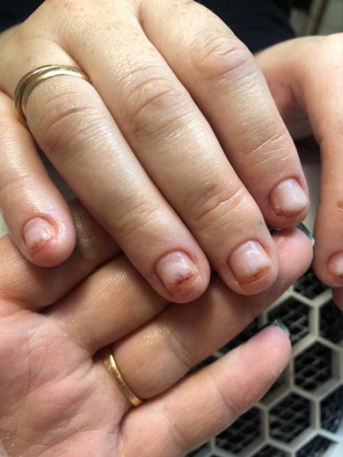 Аллергия на гель - лак: причины, симптомы, лечение. 04 Аллергия на гель - лак: причины, симптомы, лечение. 04