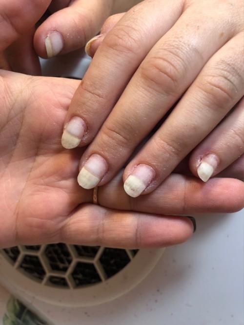 Аллергия на гель - лак: причины, симптомы, лечение. 02 Аллергия на гель - лак: причины, симптомы, лечение. 02