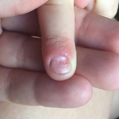 Девочки!  Столкнулась с такой проблемой, у сестры что-то с ноготочком, не пойму что именно. 01