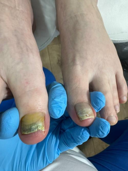 Ониходистрофия - любое нарушение структуры и роста ногтевой пластины. 03 Ониходистрофия - любое нарушение структуры и роста ногтевой пластины. 03