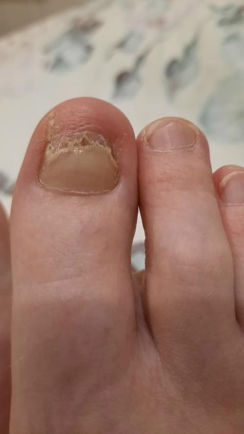 Ониходистрофия - любое нарушение структуры и роста ногтевой пластины. 01 Ониходистрофия - любое нарушение структуры и роста ногтевой пластины. 01