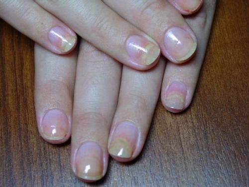 Отслоение ногтя - это заметный, неприятный, бросающийся в глаза дефект. 01 Отслоение ногтя - это заметный, неприятный, бросающийся в глаза дефект. 01