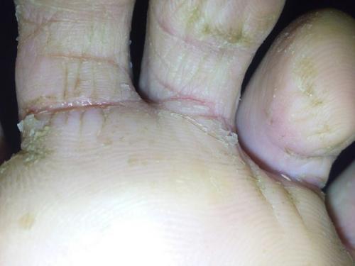 Девочки помогите!  У мужа с ножками такая беда. 01