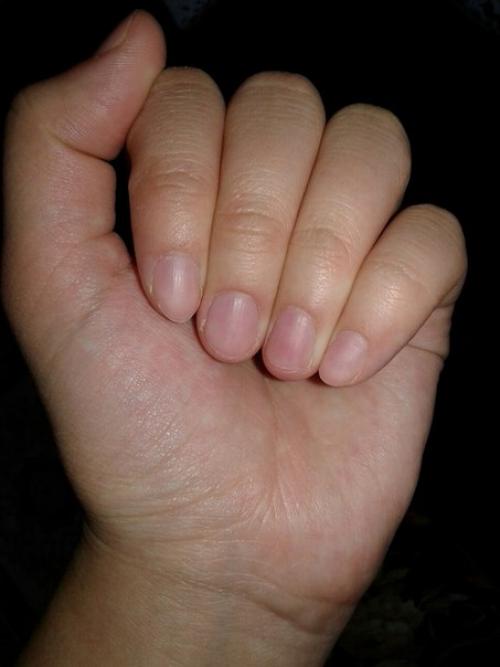 Всем привет!  Девочки, подскажите, у меня на среднем и указательных пальцах был онихолизис. 01
