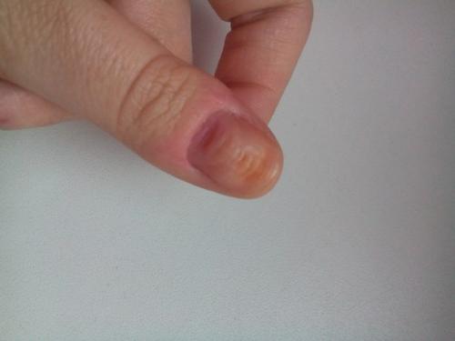 Что это?  Оба этих ногтя очень бугристые (остальные ногти в нормальном состоянии (наращивание не делала. 01