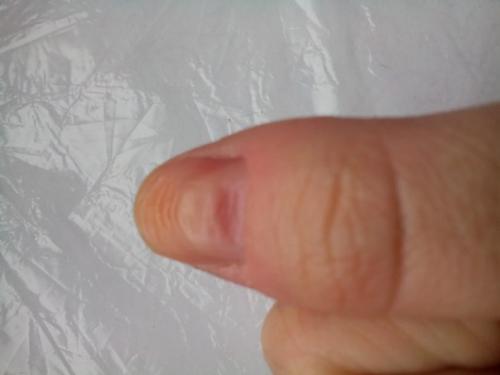 Что это?  Оба этих ногтя очень бугристые (остальные ногти в нормальном состоянии (наращивание не делала. 02