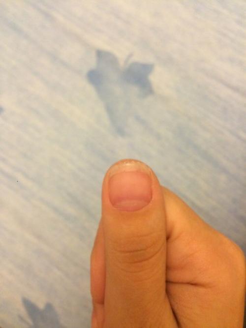 Девочки, привет. Подскажите пожалуйста, что это может быть ( только на одном большом пальчике, неприятно щипит и трескается. 02