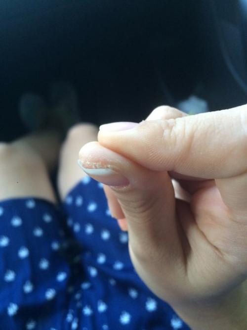 Девочки, привет. Подскажите пожалуйста, что это может быть ( только на одном большом пальчике, неприятно щипит и трескается. 01