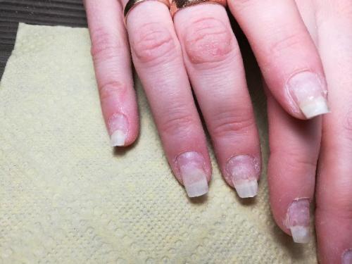 Подскажите что у девочки с ногтями может быть? 01
