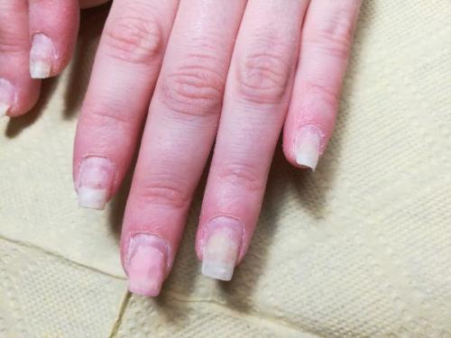 Подскажите что у девочки с ногтями может быть? 02