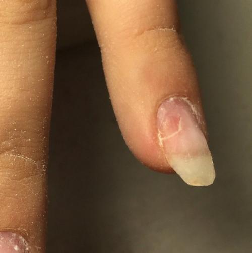 Всем привет!  Клиентка как пол года делает гель лак и вот и вот на очередной коррекции наблюдаю такую картину. 02