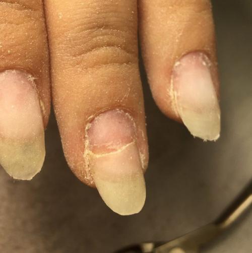 Всем привет!  Клиентка как пол года делает гель лак и вот и вот на очередной коррекции наблюдаю такую картину. 01