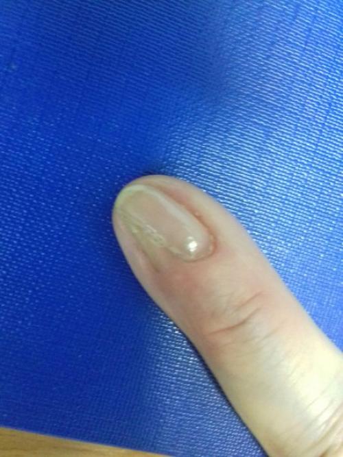 Дорогие мастера.  У моей знакомой проблема с ногтем ( была удалена половина ногтевой пластины и она не растет. 01