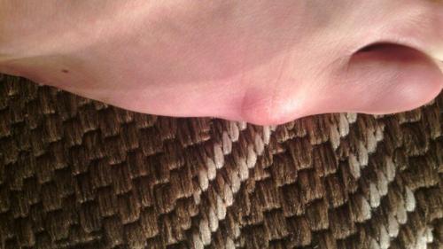 Анон.  Девочки феячки подскажите, поделитесь опытом, может у кого то такое было, как убрать такую мозоль или как это назвать даже не знаю! 02