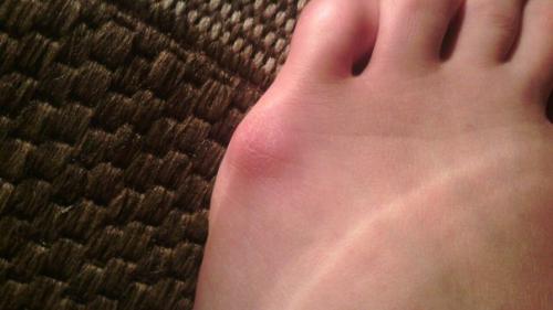 Анон.  Девочки феячки подскажите, поделитесь опытом, может у кого то такое было, как убрать такую мозоль или как это назвать даже не знаю! 01