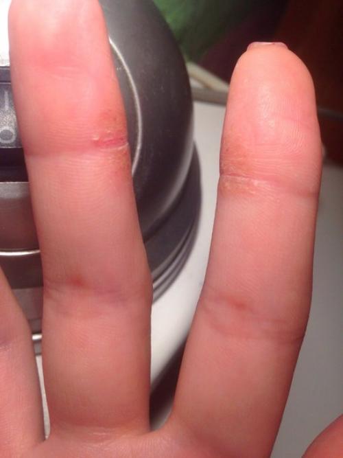 Девочки, подскажите мне, что делать, думаю уже к дерматологу идти! 01