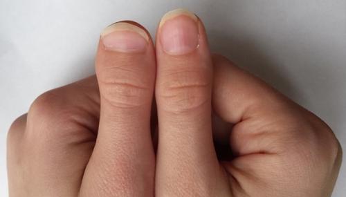 Палец убийцы. По - научному, брахидактилия - генетическое заболевание, которое развивается из-за мутации генов, влияющей на рост костей. 01