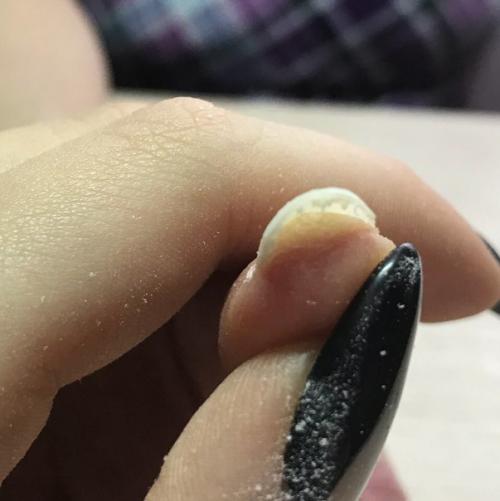 Отходит ногтевая пластина, почему так происходит? 01