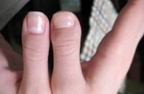 Палец убийцы. По - научному, брахидактилия - генетическое заболевание, которое развивается из-за мутации генов, влияющей на рост костей. 02