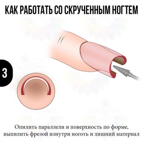 Как работать со скрученным ногтем? 02