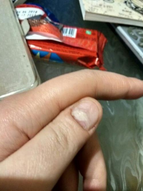 Девочки, Help!  Палец у основания ножом поранила. 02