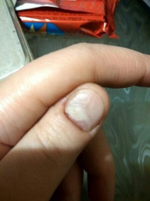 Девочки, Help!  Палец у основания ножом поранила. 01