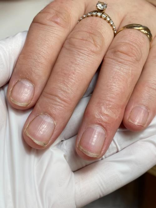 5 недель назад эти ногти были вот в таком состоянии …. 01 5 недель назад эти ногти были вот в таком состоянии …. 01