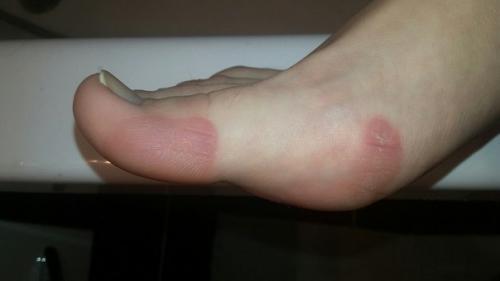 Анонимно пожалуйста!  Подскажите что со ступнями, пятками, пальцами? 04