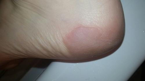 Анонимно пожалуйста!  Подскажите что со ступнями, пятками, пальцами? 01