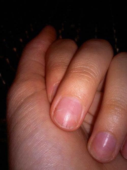 Черные полоски на ногтях фото что это такое