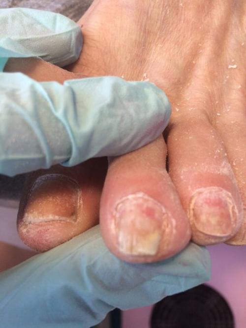 Девочки, это грибок? 01