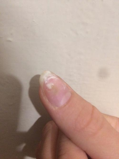 Мастерицы подскажите пожалуйста что за зеленоватое пятнышко, когда нажимаешь болит, появилось после гель лака. 01