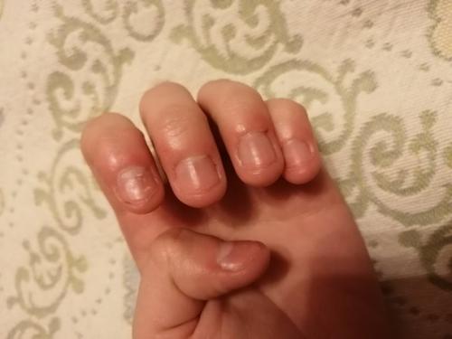 Ногти в ужасном состоянии, грызла на протяжении 17 лет, сколько раз не пыталась бросить эту привычку - не получается. 01